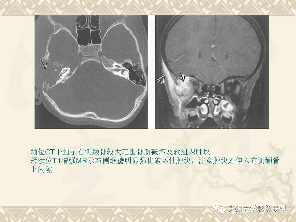 影像PPT - 【PPT】颅骨肿瘤的影像学诊断与鉴别诊断-42