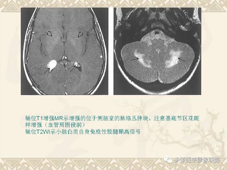 影像PPT - 【PPT】颅骨肿瘤的影像学诊断与鉴别诊断-43