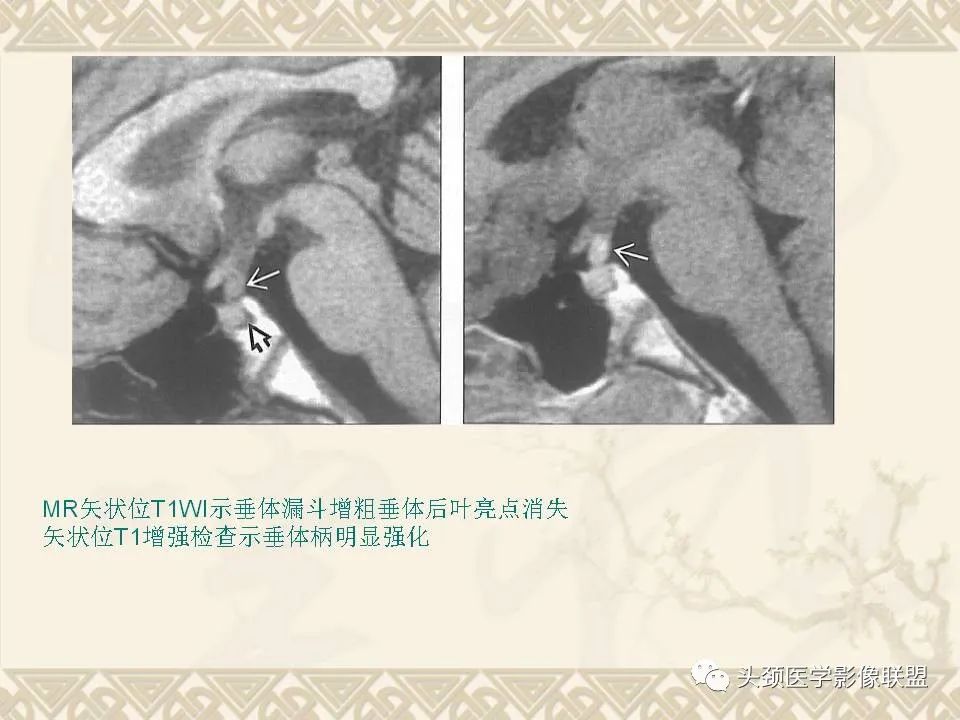 影像PPT - 【PPT】颅骨肿瘤的影像学诊断与鉴别诊断-44