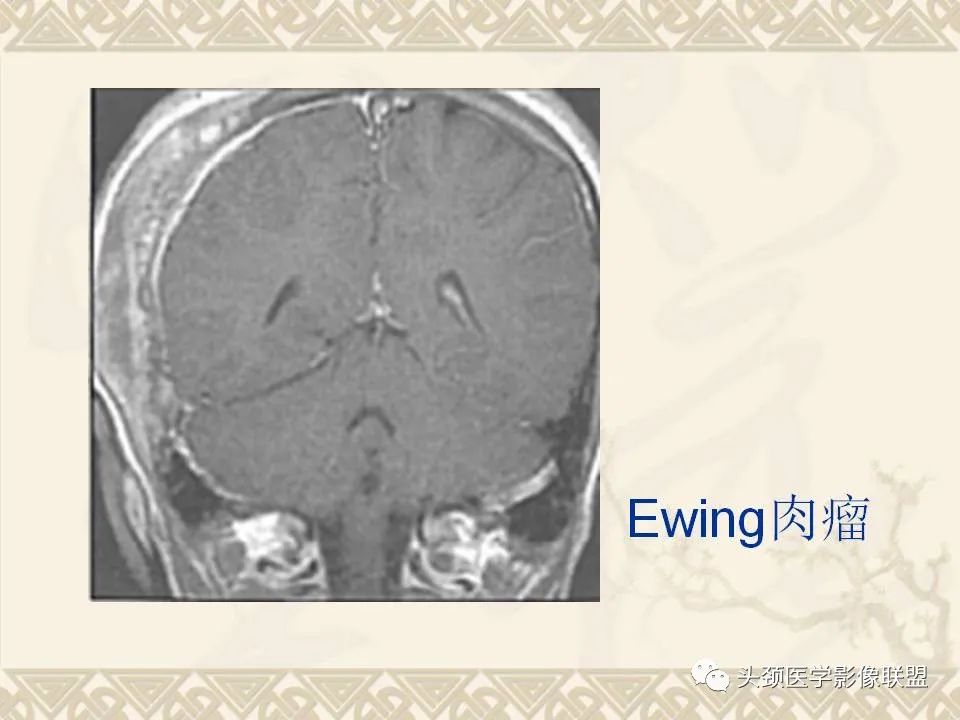 影像PPT - 【PPT】颅骨肿瘤的影像学诊断与鉴别诊断-46