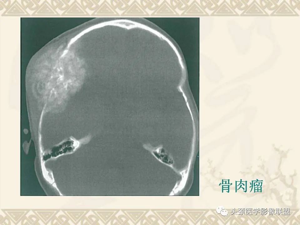 影像PPT - 【PPT】颅骨肿瘤的影像学诊断与鉴别诊断-48