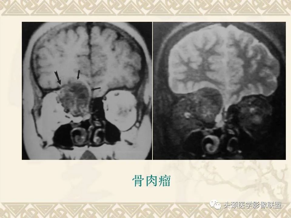 影像PPT - 【PPT】颅骨肿瘤的影像学诊断与鉴别诊断-50