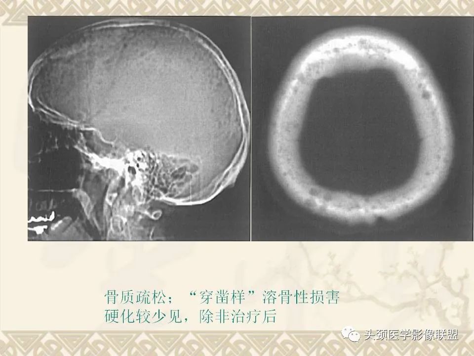 影像PPT - 【PPT】颅骨肿瘤的影像学诊断与鉴别诊断-52