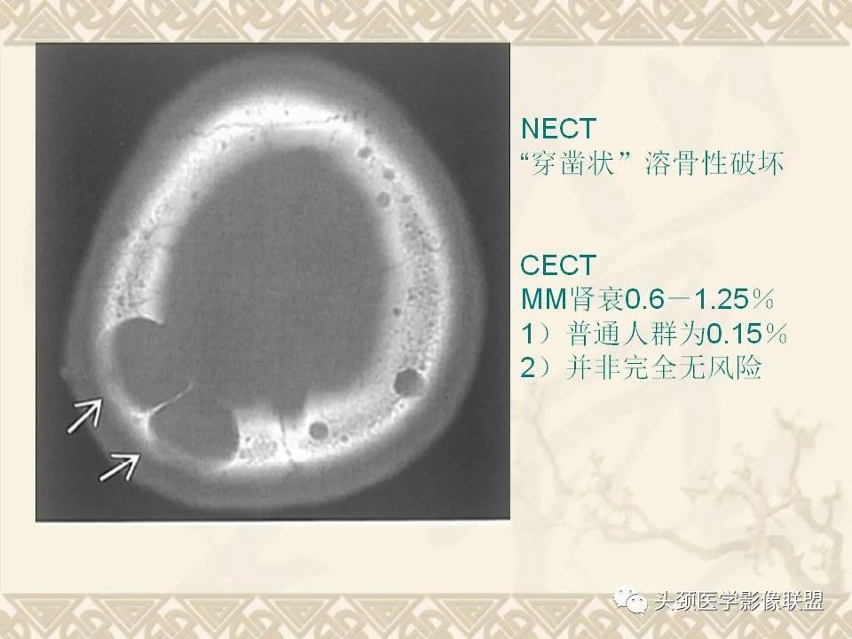 影像PPT - 【PPT】颅骨肿瘤的影像学诊断与鉴别诊断-53