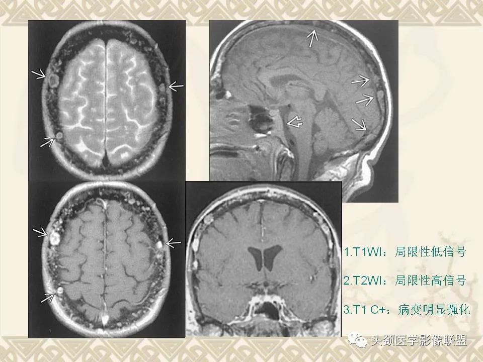 影像PPT - 【PPT】颅骨肿瘤的影像学诊断与鉴别诊断-54