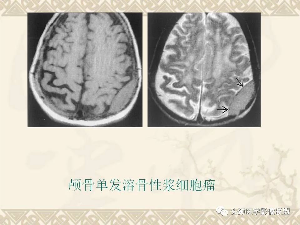 影像PPT - 【PPT】颅骨肿瘤的影像学诊断与鉴别诊断-55
