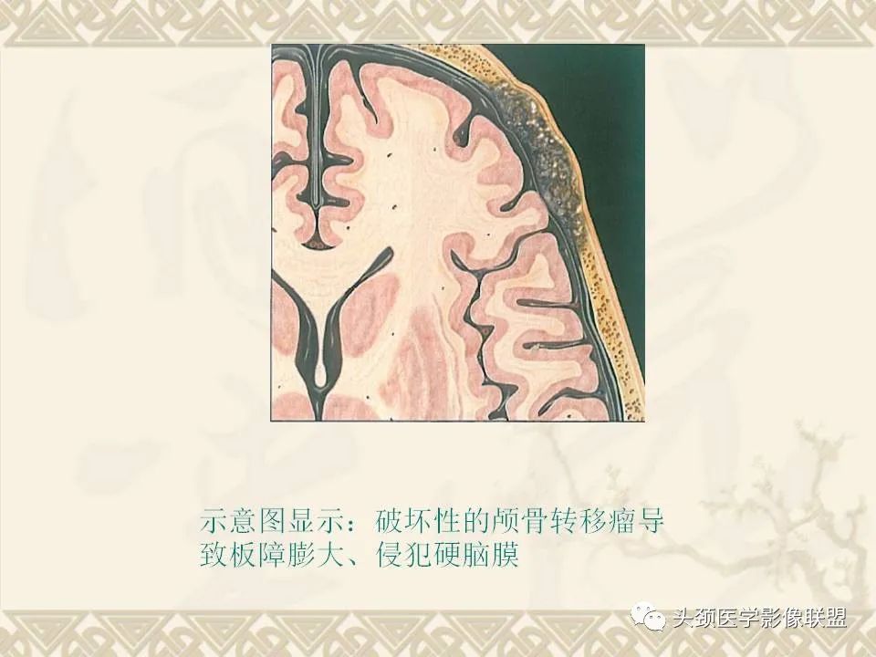 影像PPT - 【PPT】颅骨肿瘤的影像学诊断与鉴别诊断-57