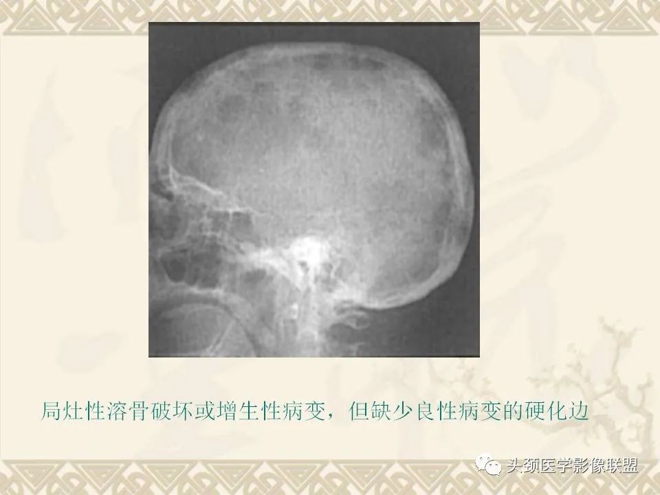 影像PPT - 【PPT】颅骨肿瘤的影像学诊断与鉴别诊断-58