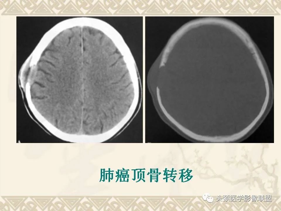 影像PPT - 【PPT】颅骨肿瘤的影像学诊断与鉴别诊断-59