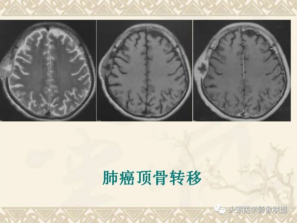 影像PPT - 【PPT】颅骨肿瘤的影像学诊断与鉴别诊断-60