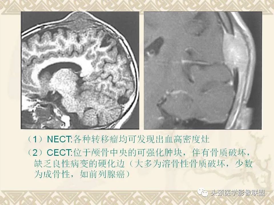 影像PPT - 【PPT】颅骨肿瘤的影像学诊断与鉴别诊断-61