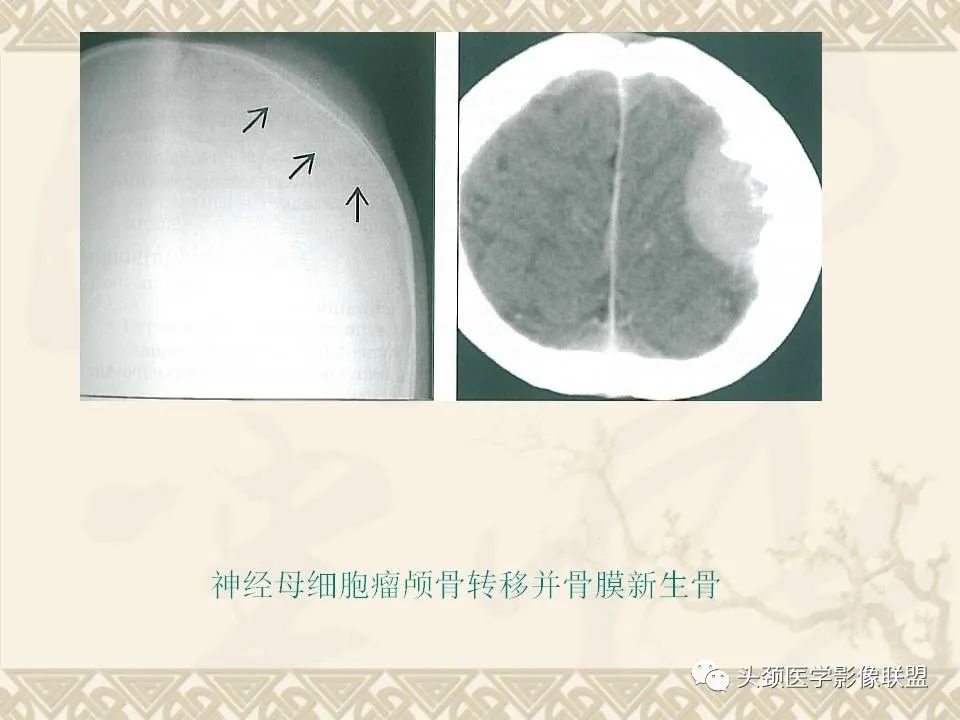 影像PPT - 【PPT】颅骨肿瘤的影像学诊断与鉴别诊断-62