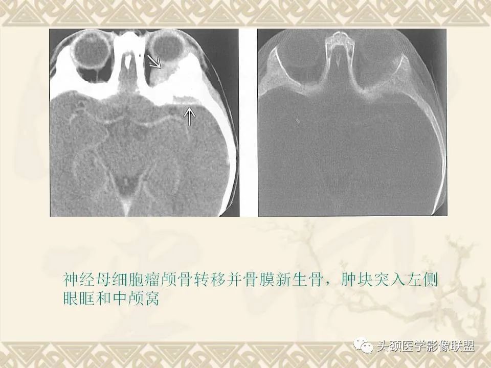 影像PPT - 【PPT】颅骨肿瘤的影像学诊断与鉴别诊断-63