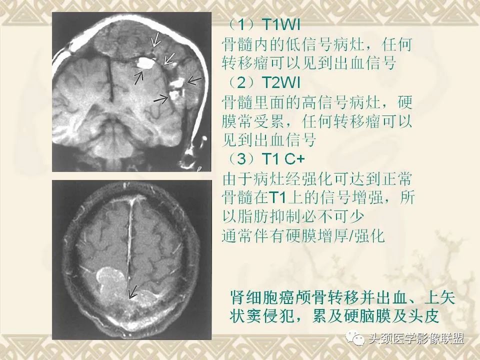影像PPT - 【PPT】颅骨肿瘤的影像学诊断与鉴别诊断-64
