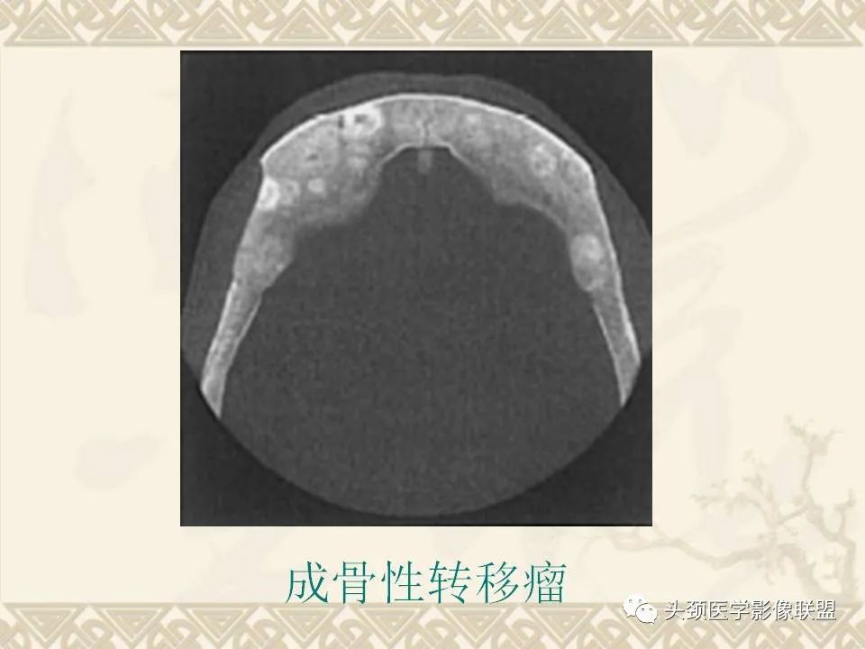 影像PPT - 【PPT】颅骨肿瘤的影像学诊断与鉴别诊断-65