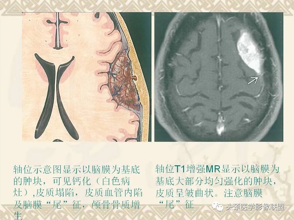 影像PPT - 【PPT】颅骨肿瘤的影像学诊断与鉴别诊断-67