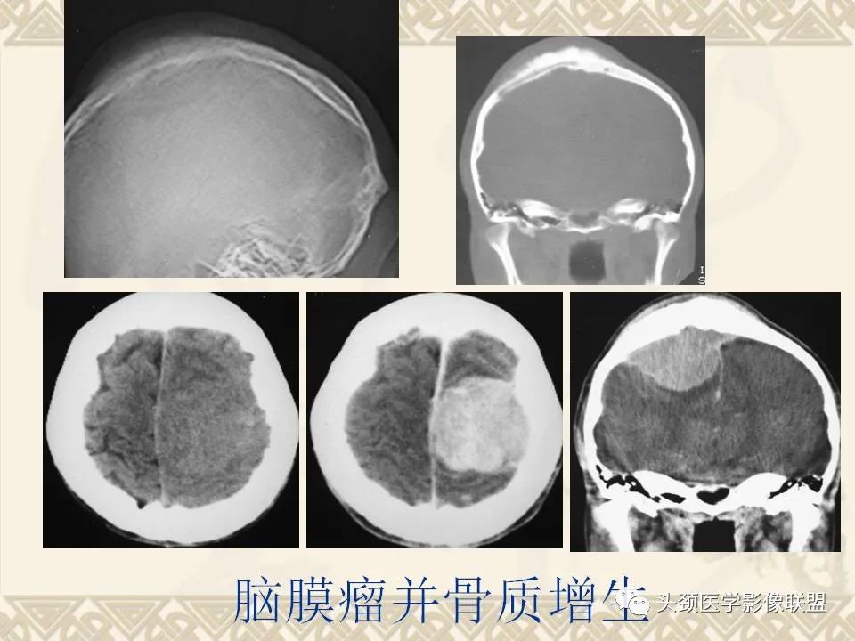 影像PPT - 【PPT】颅骨肿瘤的影像学诊断与鉴别诊断-68