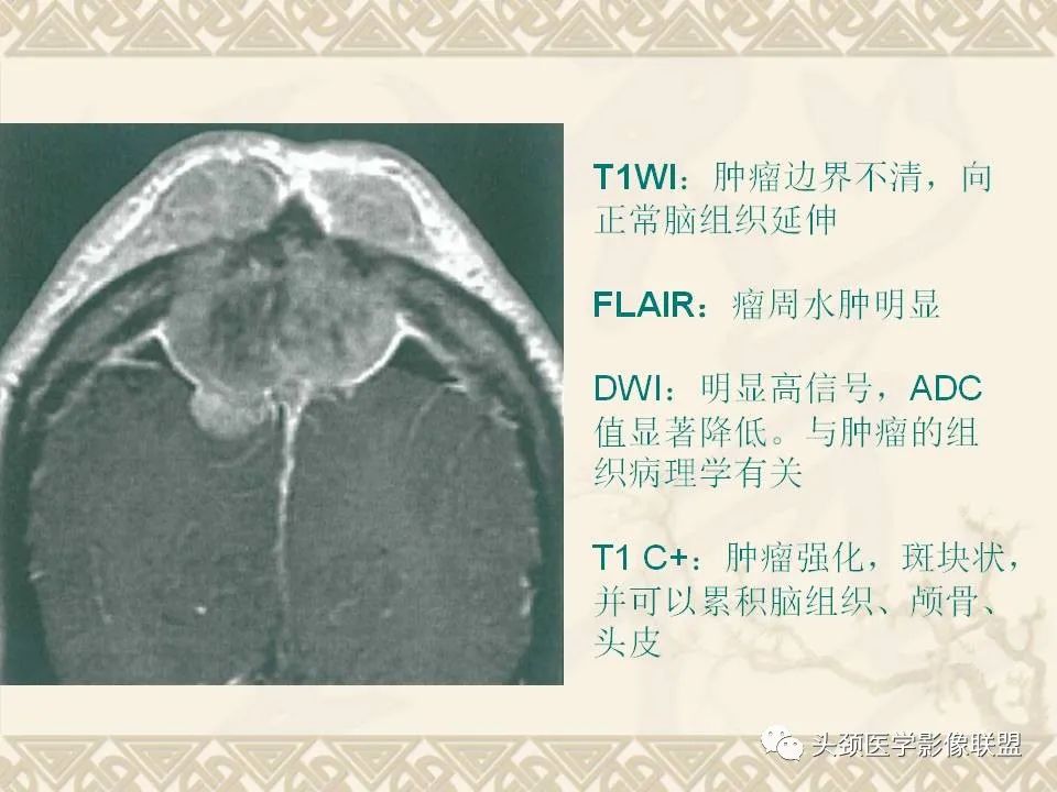 影像PPT - 【PPT】颅骨肿瘤的影像学诊断与鉴别诊断-70