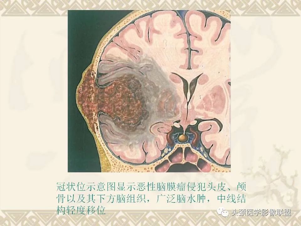 影像PPT - 【PPT】颅骨肿瘤的影像学诊断与鉴别诊断-69
