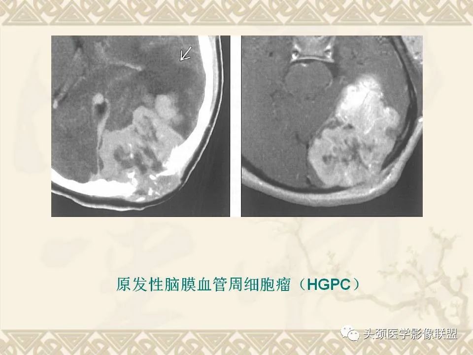 影像PPT - 【PPT】颅骨肿瘤的影像学诊断与鉴别诊断-75
