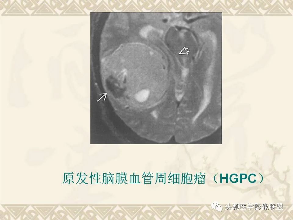 影像PPT - 【PPT】颅骨肿瘤的影像学诊断与鉴别诊断-74