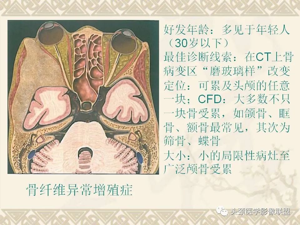 影像PPT - 【PPT】颅骨肿瘤的影像学诊断与鉴别诊断-77