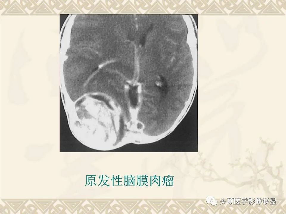 影像PPT - 【PPT】颅骨肿瘤的影像学诊断与鉴别诊断-73