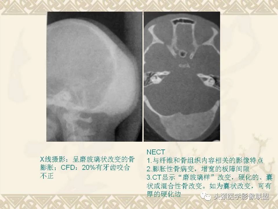 影像PPT - 【PPT】颅骨肿瘤的影像学诊断与鉴别诊断-78