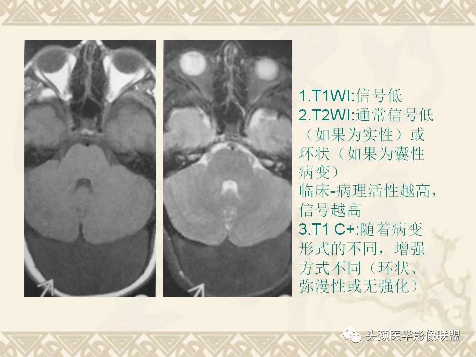 影像PPT - 【PPT】颅骨肿瘤的影像学诊断与鉴别诊断-79