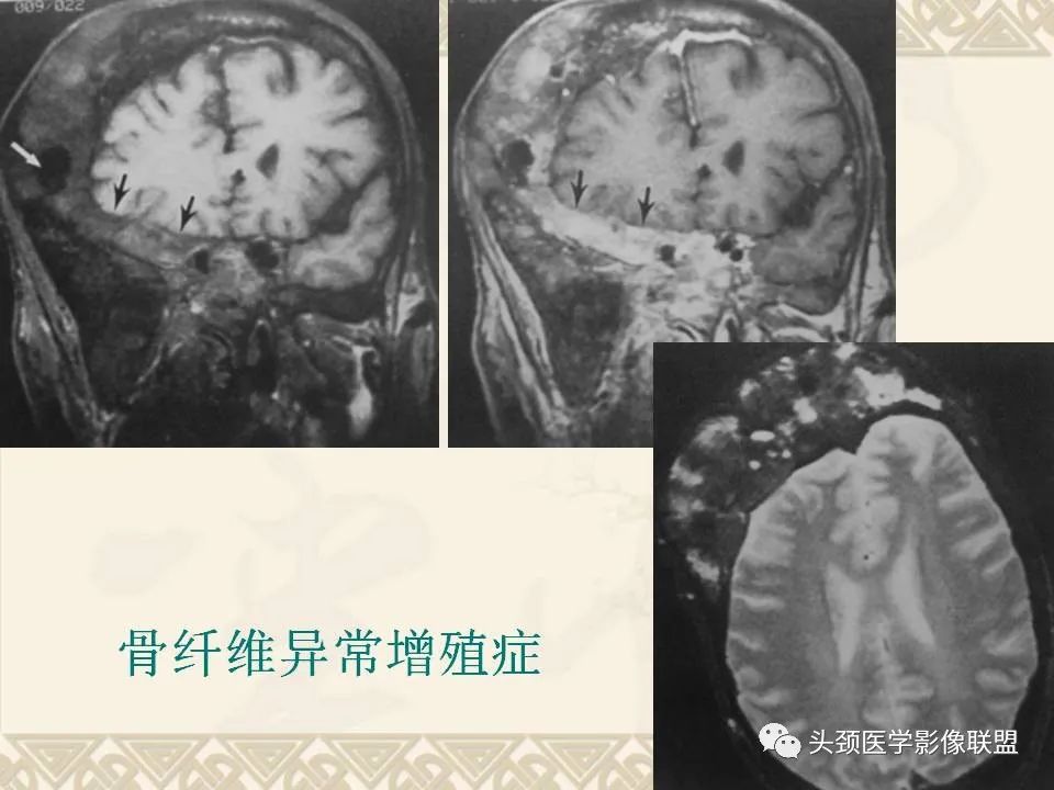 影像PPT - 【PPT】颅骨肿瘤的影像学诊断与鉴别诊断-82