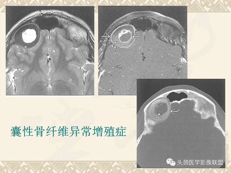 影像PPT - 【PPT】颅骨肿瘤的影像学诊断与鉴别诊断-81