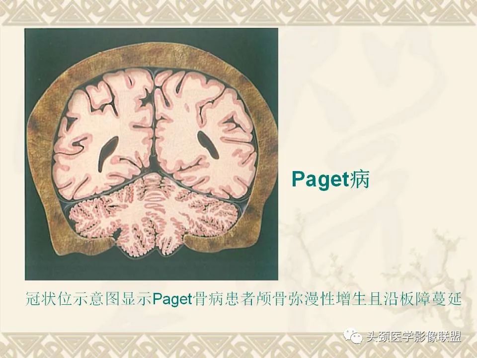 影像PPT - 【PPT】颅骨肿瘤的影像学诊断与鉴别诊断-83