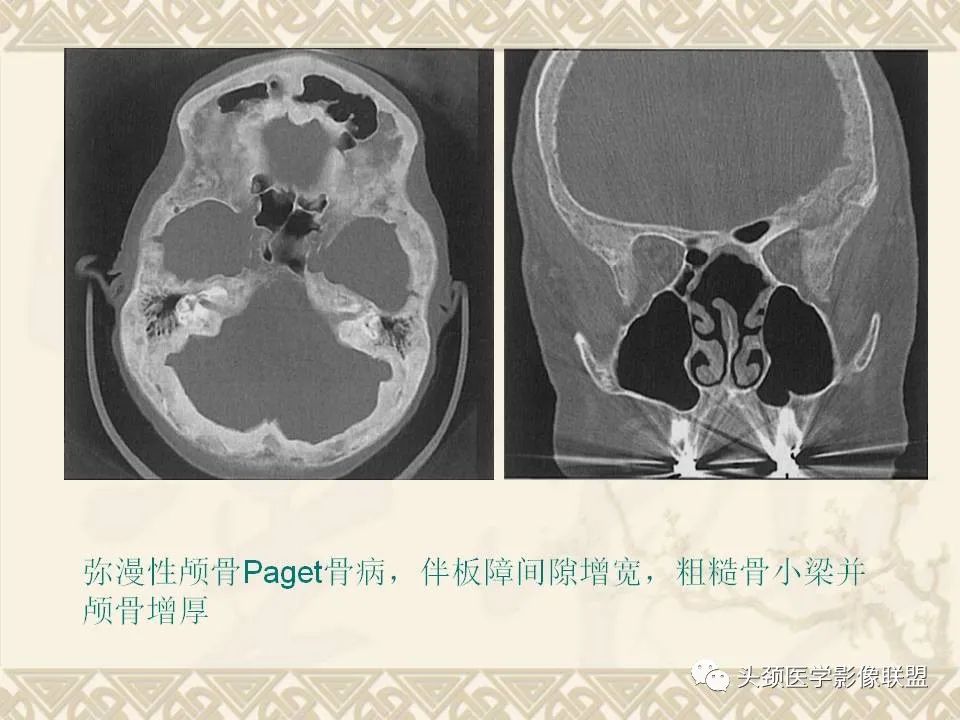 影像PPT - 【PPT】颅骨肿瘤的影像学诊断与鉴别诊断-85
