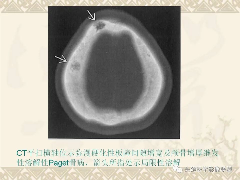 影像PPT - 【PPT】颅骨肿瘤的影像学诊断与鉴别诊断-86
