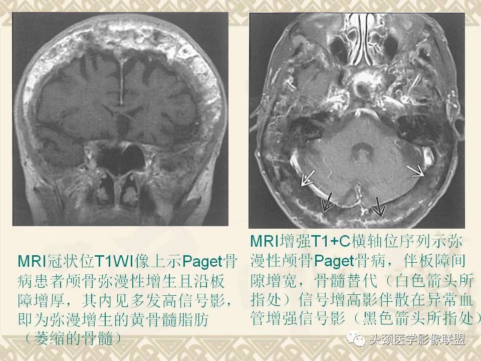 影像PPT - 【PPT】颅骨肿瘤的影像学诊断与鉴别诊断-87