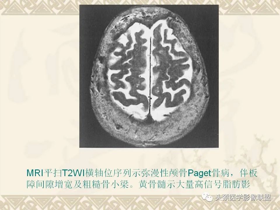 影像PPT - 【PPT】颅骨肿瘤的影像学诊断与鉴别诊断-88