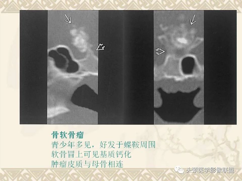 影像PPT - 【PPT】颅骨肿瘤的影像学诊断与鉴别诊断-90