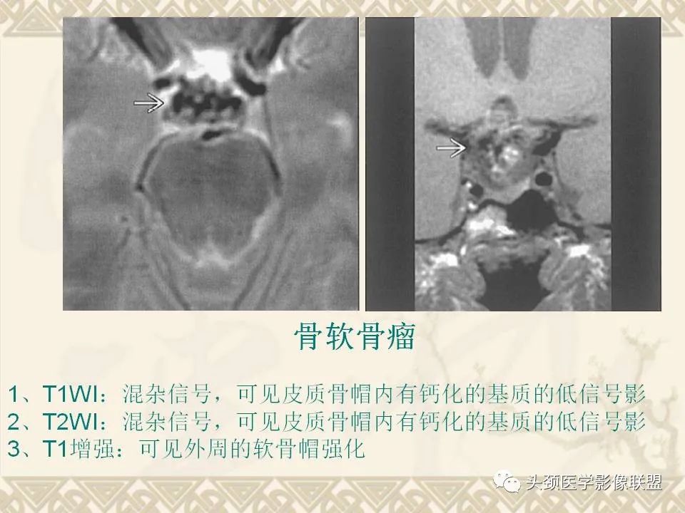 影像PPT - 【PPT】颅骨肿瘤的影像学诊断与鉴别诊断-91