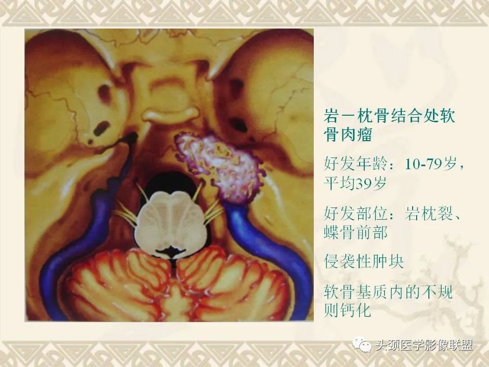 影像PPT - 【PPT】颅骨肿瘤的影像学诊断与鉴别诊断-93