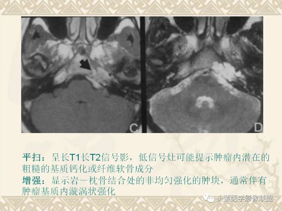 影像PPT - 【PPT】颅骨肿瘤的影像学诊断与鉴别诊断-95
