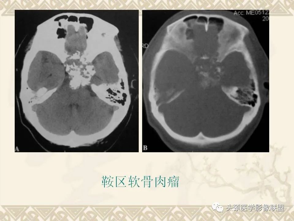影像PPT - 【PPT】颅骨肿瘤的影像学诊断与鉴别诊断-96