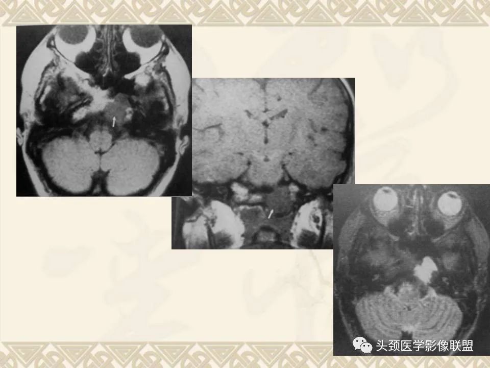 影像PPT - 【PPT】颅骨肿瘤的影像学诊断与鉴别诊断-97
