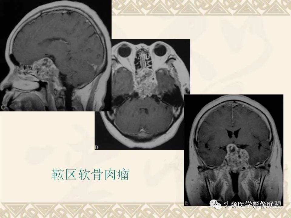 影像PPT - 【PPT】颅骨肿瘤的影像学诊断与鉴别诊断-98