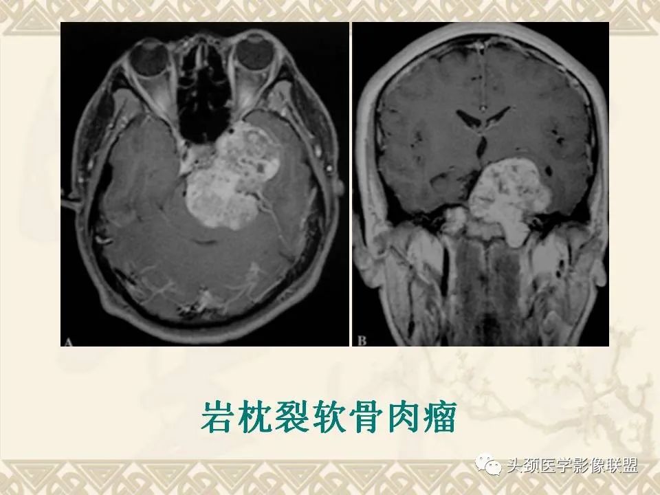 影像PPT - 【PPT】颅骨肿瘤的影像学诊断与鉴别诊断-99