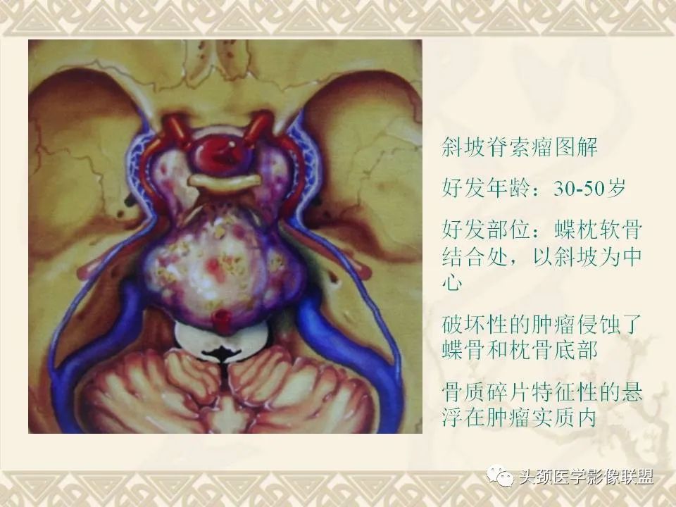 影像PPT - 【PPT】颅骨肿瘤的影像学诊断与鉴别诊断-100