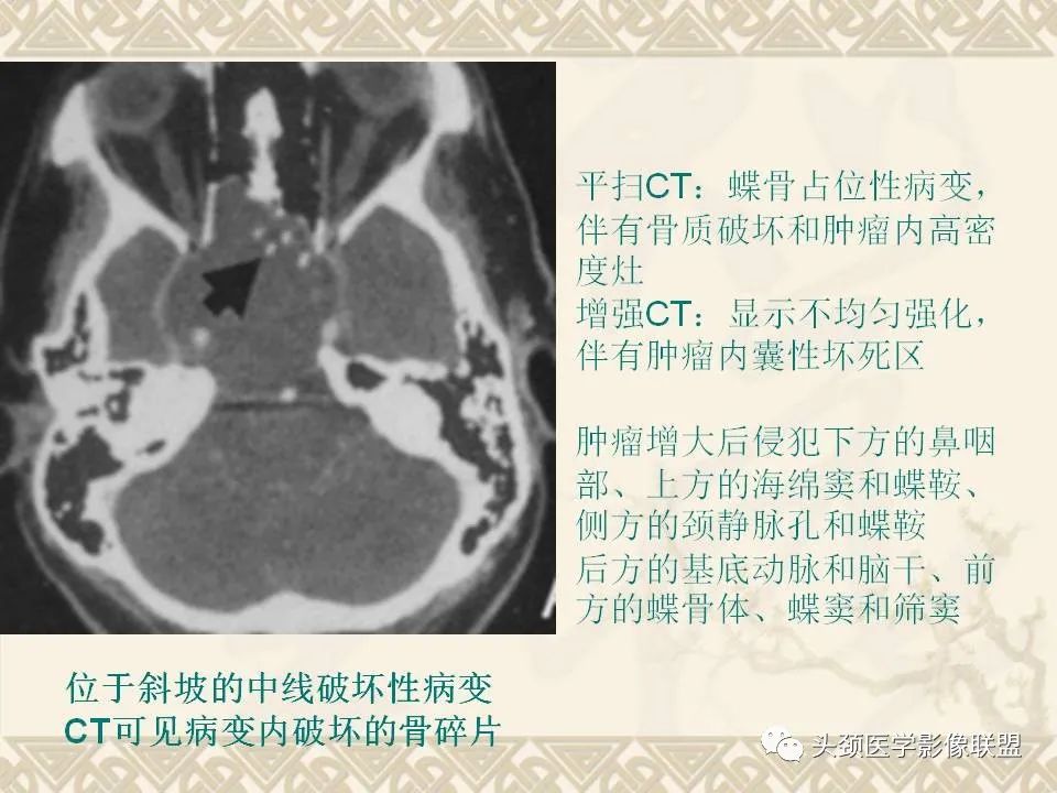 影像PPT - 【PPT】颅骨肿瘤的影像学诊断与鉴别诊断-101