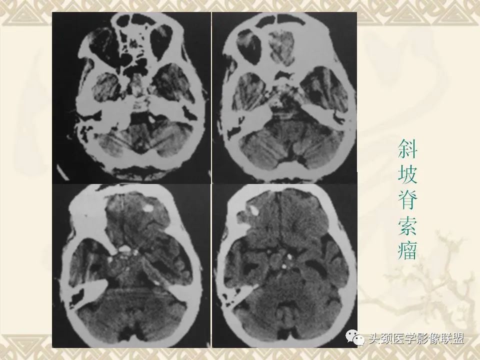 影像PPT - 【PPT】颅骨肿瘤的影像学诊断与鉴别诊断-102