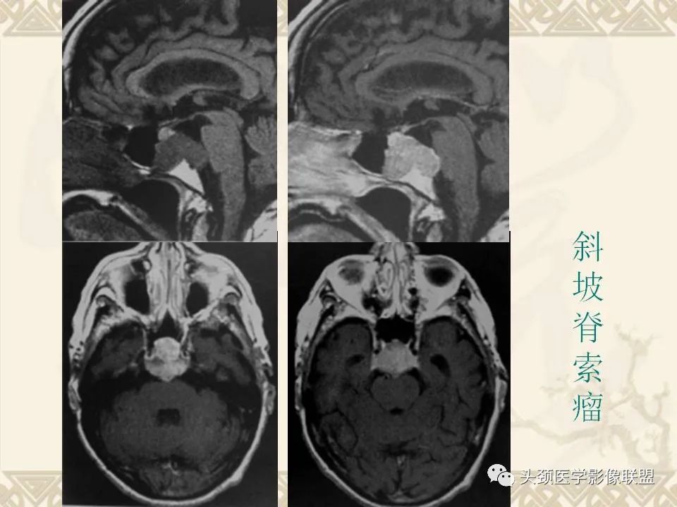 影像PPT - 【PPT】颅骨肿瘤的影像学诊断与鉴别诊断-103