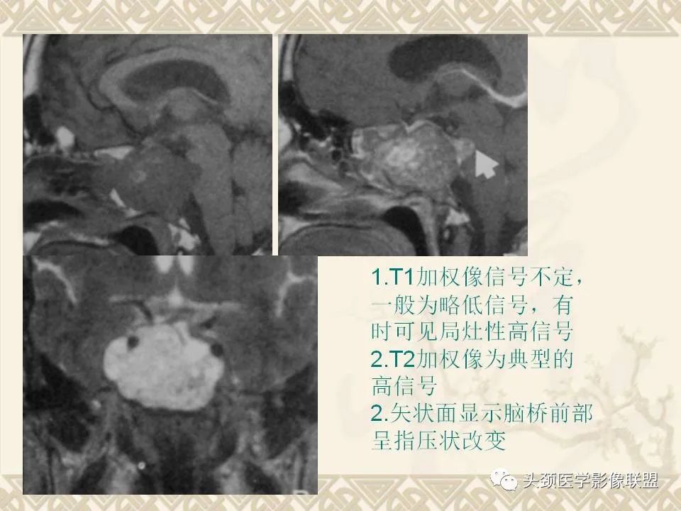 影像PPT - 【PPT】颅骨肿瘤的影像学诊断与鉴别诊断-104