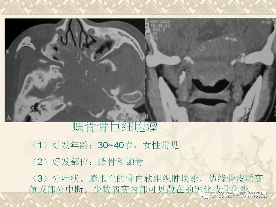 影像PPT - 【PPT】颅骨肿瘤的影像学诊断与鉴别诊断-106